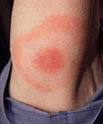 Tick Bite