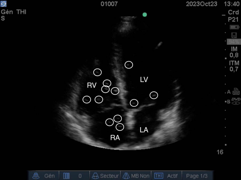 Cardiac ultrasound image recorded following a heliox dive, with circles identifying gas bubbles. RV: right ventricle; LV: left ventricle; RA: right atrium; LA: left atrium. Image credit: Erwan L'Her, supplied by Dr Emmanuel Gouin.